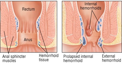 What is a hemroid - What are hemroids