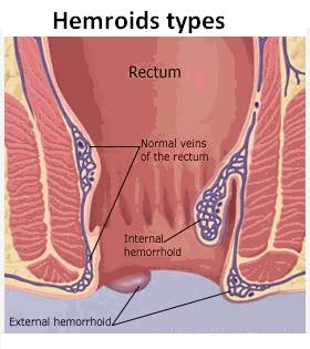 Hemroid symptoms - Internal hemroids and external hemroids